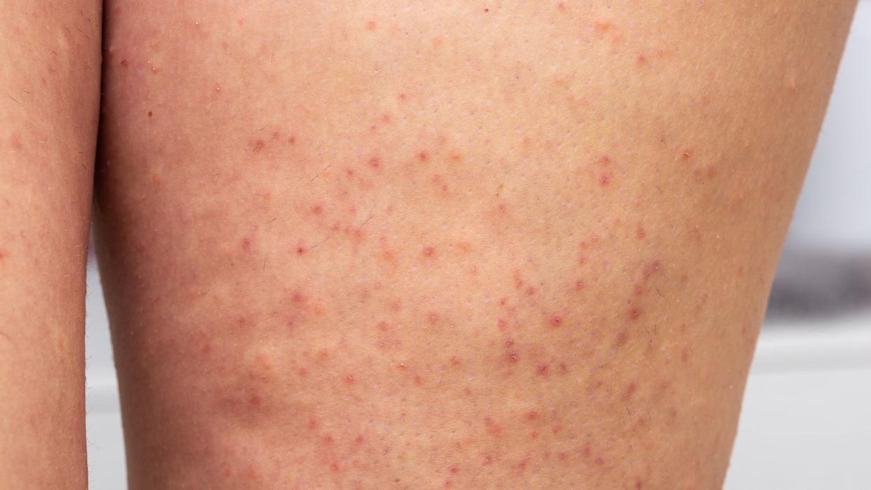 a white woman's leg with red bumps, indicating razor burn