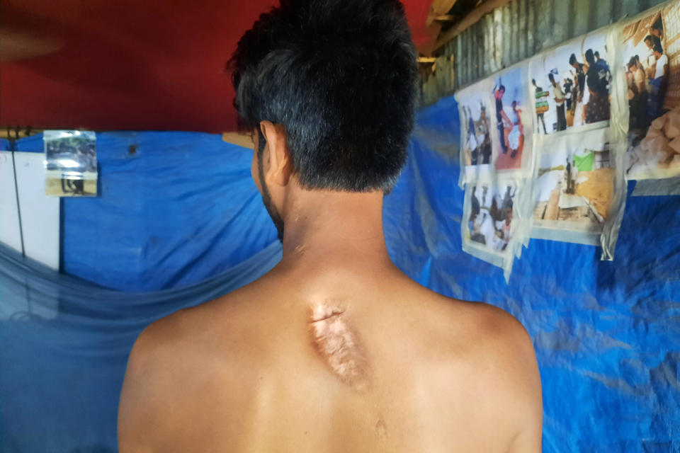 Shaiful, 22, says the Myanmar military shot him in the back in 2017. (Azimul Hasson )