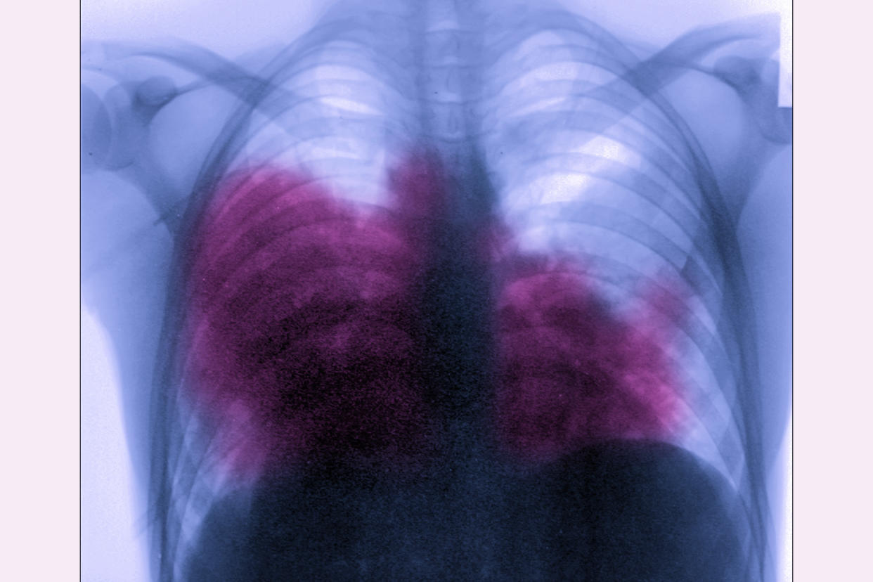Acute bilateral pneumonia, aka Legionnaires' disease, is seen on a chest X-ray. (Photo: BSIP/UIG via Getty Images)