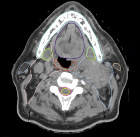 Unedited head-and-neck image generated by the RefleXion® X1 displays excellent contrast and detail resolution, and near-perfect Limbus AI contours visible on several structures. (Photo: Business Wire)