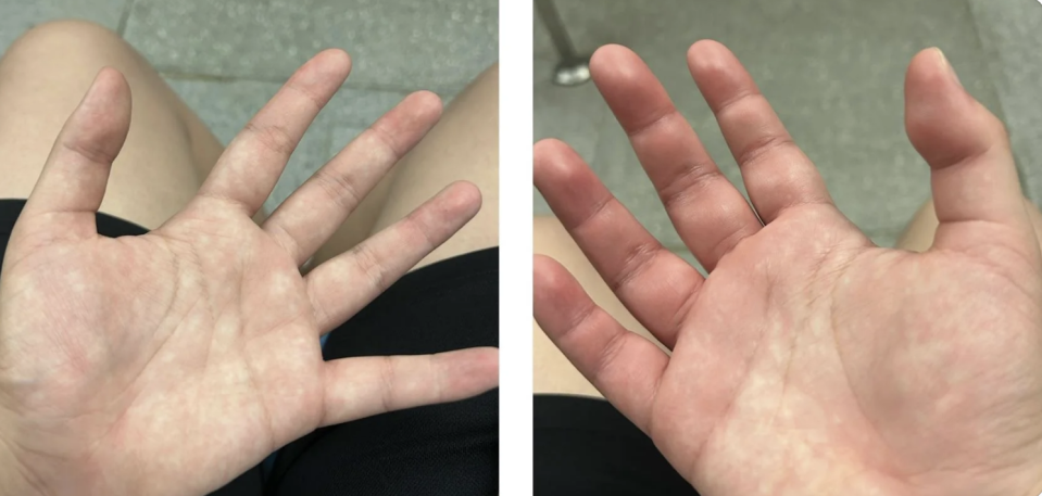 Two photos showing open hands with bent fingertips in different positions, possibly indicating a medical condition