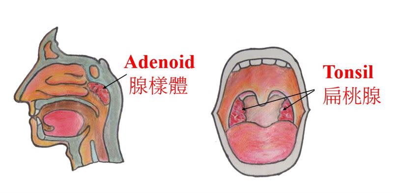 康焜泰醫師表示，兒童睡眠呼吸中止症一般以切除扁桃腺與腺樣體手術可治癒（圖／台北醫院提供）