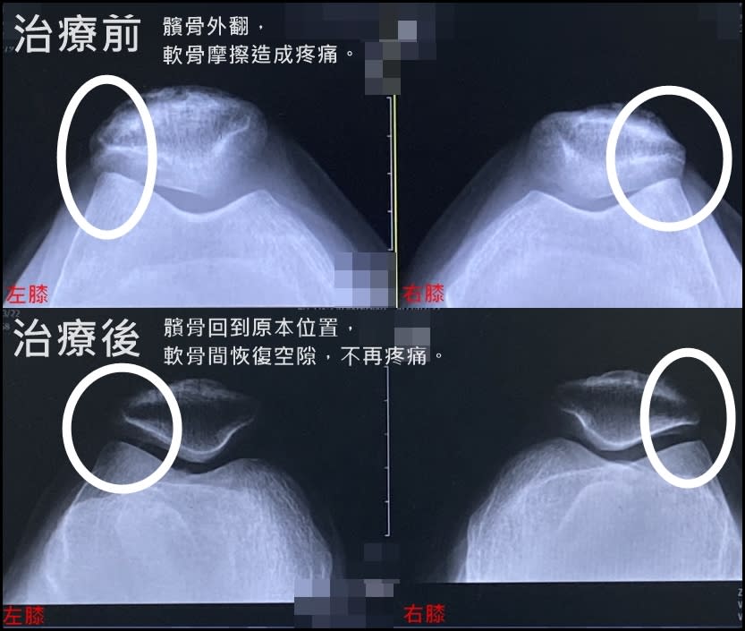 如果髕骨傾斜、外翻，髕骨的軟骨與股骨的軟骨就會對磨，此時病人就會有蹲下去、站不起來的症狀。圖/羅東博愛醫院提供