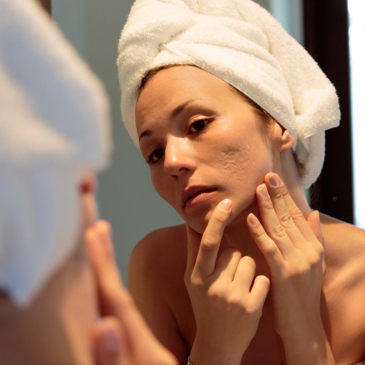  woman with acne scars using a retinoid treatment 