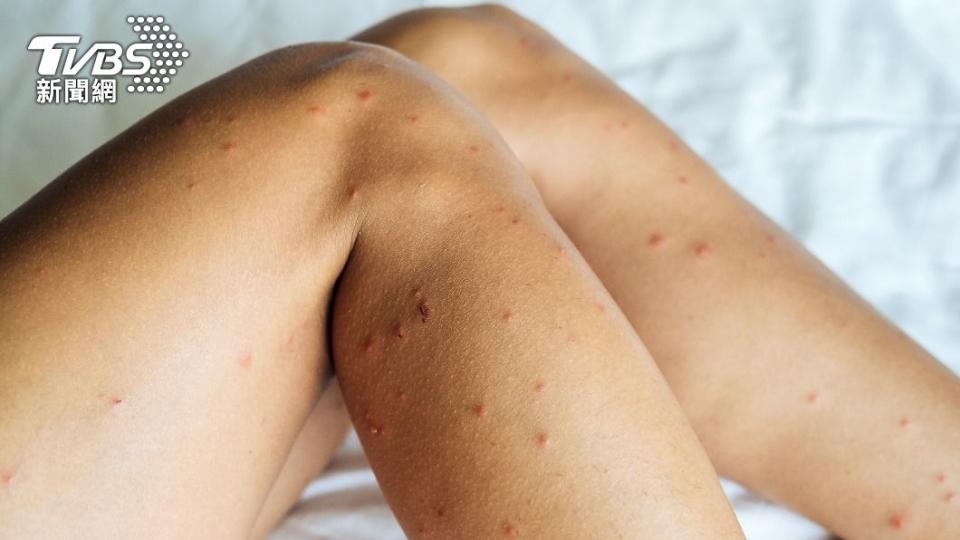 皮膚科醫師趙昭明表示，如果被蝨蟲叮咬，會出現紅腫過敏反應，通常會感覺搔癢。（示意圖／shutterstock 達志影像）