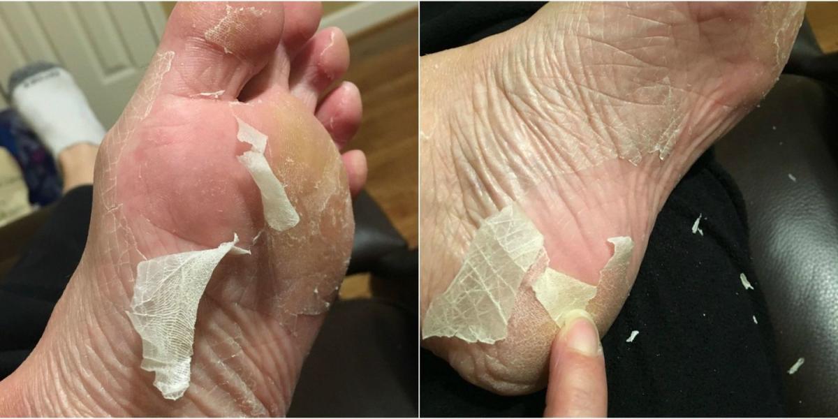 Get Amazingly Gross Results With This Internet-Famous Foot Peel