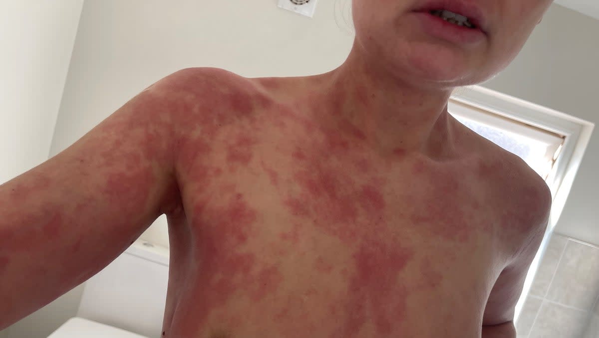 Topical steroid withdrawal can be caused after a prolonged use of steroid creams and tablets (Rhiannon Kennedy-Chapman)