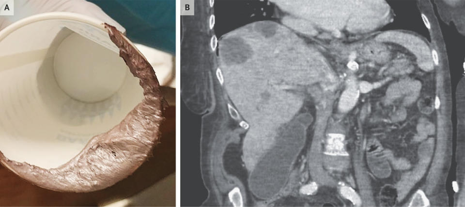 Silver stool is seen in a paper cup along with an X-ray of a woman's stomach.