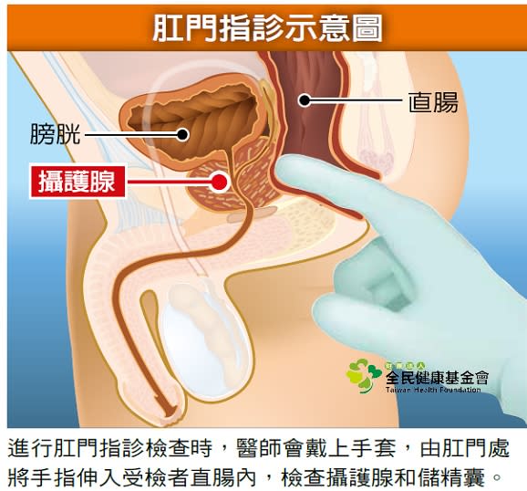 肛門指診示意圖