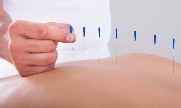 Acupuncture needles/photo courtesy of shutterstock.com