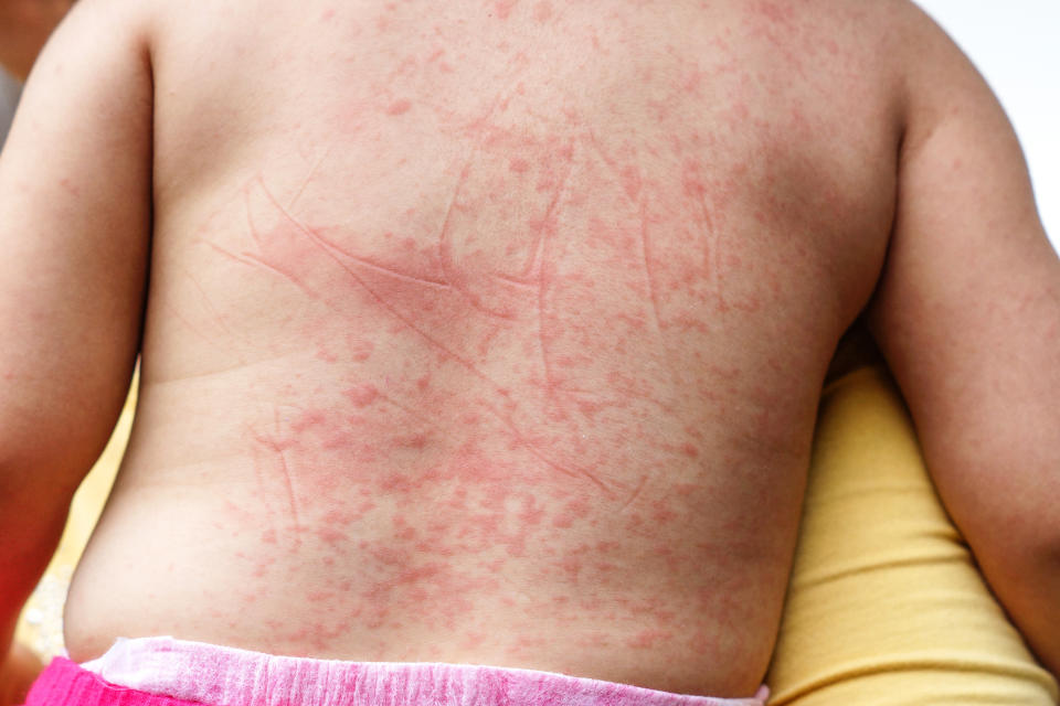 Red spots appear on baby's skin due to Dengue virus (Dengue hemorrhagic fever) - a symptom after having a high fever