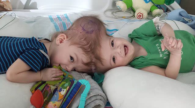 Conjoined twins Jadon and Anias. Source: Facebook