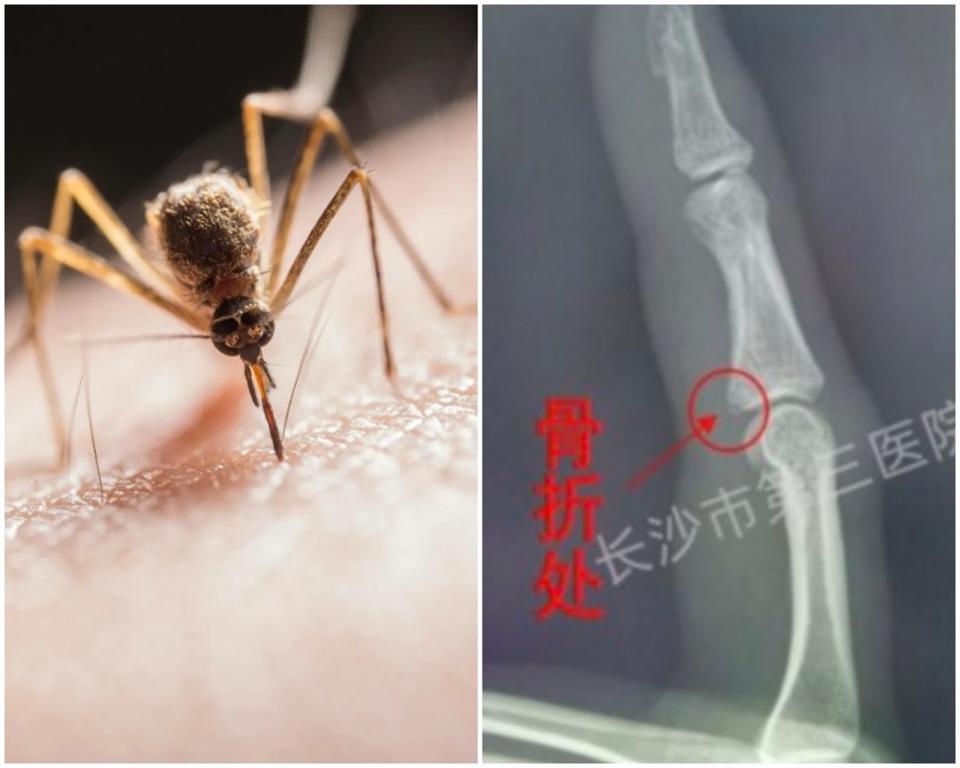 中國湖南一名女子打完蚊子之後左手指疼痛不已，到醫院檢查發現食指竟然骨折了！（圖：Pexels／微博）