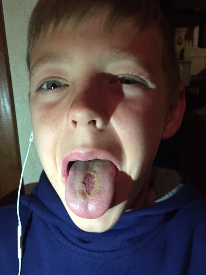 A grandmother has issued a warning after a Warhead took off the skin of her grandson's tongue. Image: Facebook/Marie Thuloweit