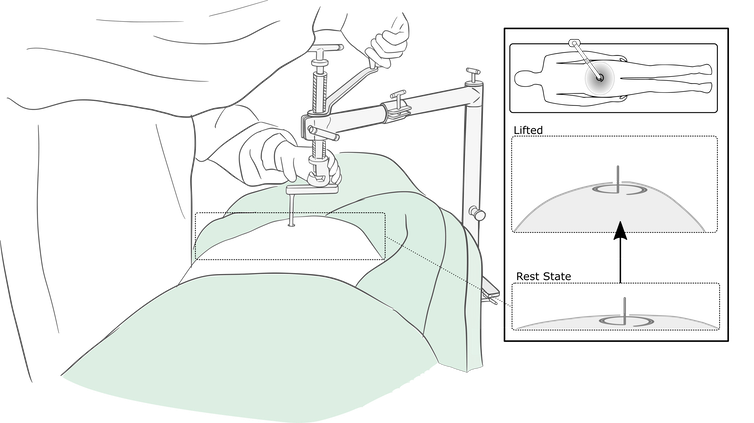 <span class="caption">Gasless laparoscopic surgery: the abdomenal wall is lifted by a ‘retractor’ to create space for instruments and a camera.</span>