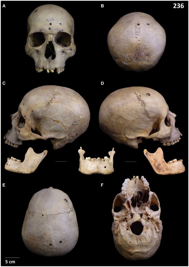 Skull 236 was found to have around 30 lesions linked to late-stage cancer. (<a href="https://www.frontiersin.org/articles/10.3389/fmed.2024.1371645/abstract" rel="nofollow noopener" target="_blank" data-ylk="slk:Tondini et al., Front. Med., 2024;elm:context_link;itc:0;sec:content-canvas" class="link ">Tondini et al., <em>Front. Med.</em>, 2024</a>)