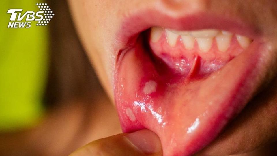 台灣地區的口腔癌以頰黏膜癌和舌癌佔多數。（示意圖／shutterstock 達志影像）