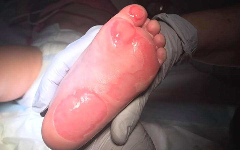 The devastated mum said her daughter may never regain full feeling in her feet following the burns. Image: Facebook/Simone Pickering