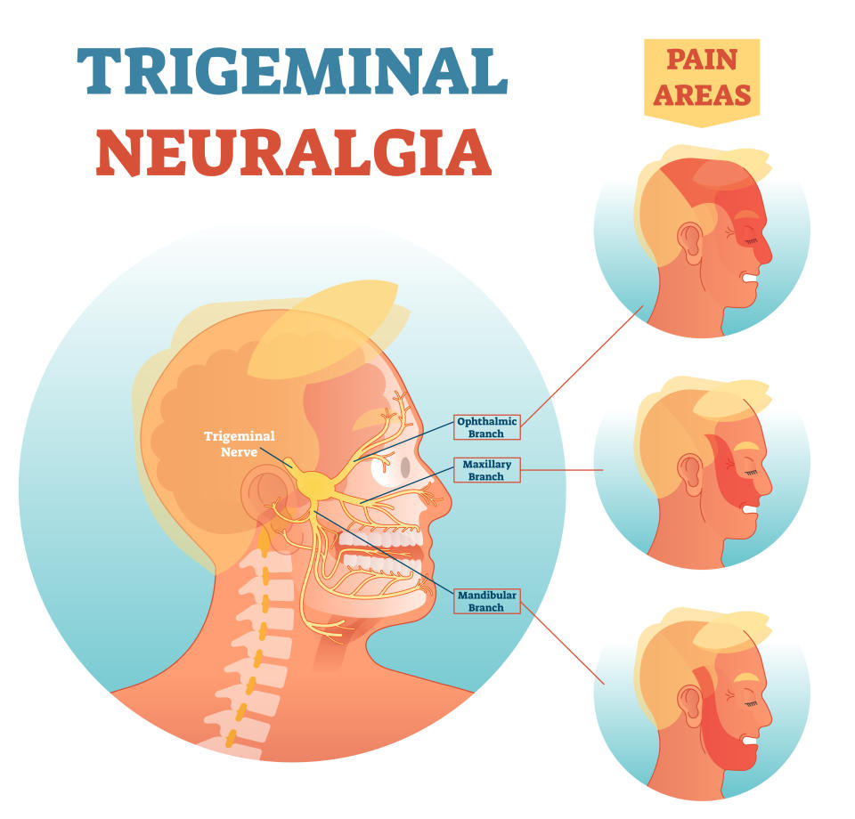 La névralgie du trijumeau est une affection qui survient lorsque la douleur provient du nerf trijumeau.  Ce nerf commence près du sommet de l’oreille et se divise en trois directions vers l’œil, la joue et la mâchoire.  (Photo via Getty Images)