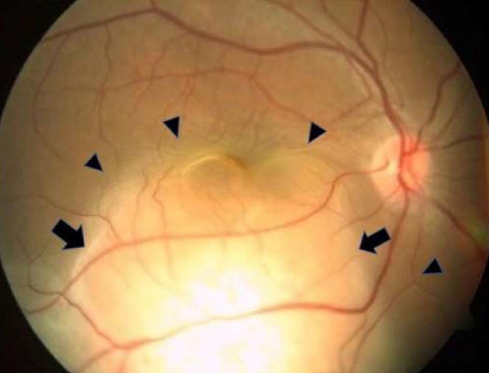 The woman was diagnosed with choroidal metastasis in both of her eyes. Singh et al/ScienceDeirect