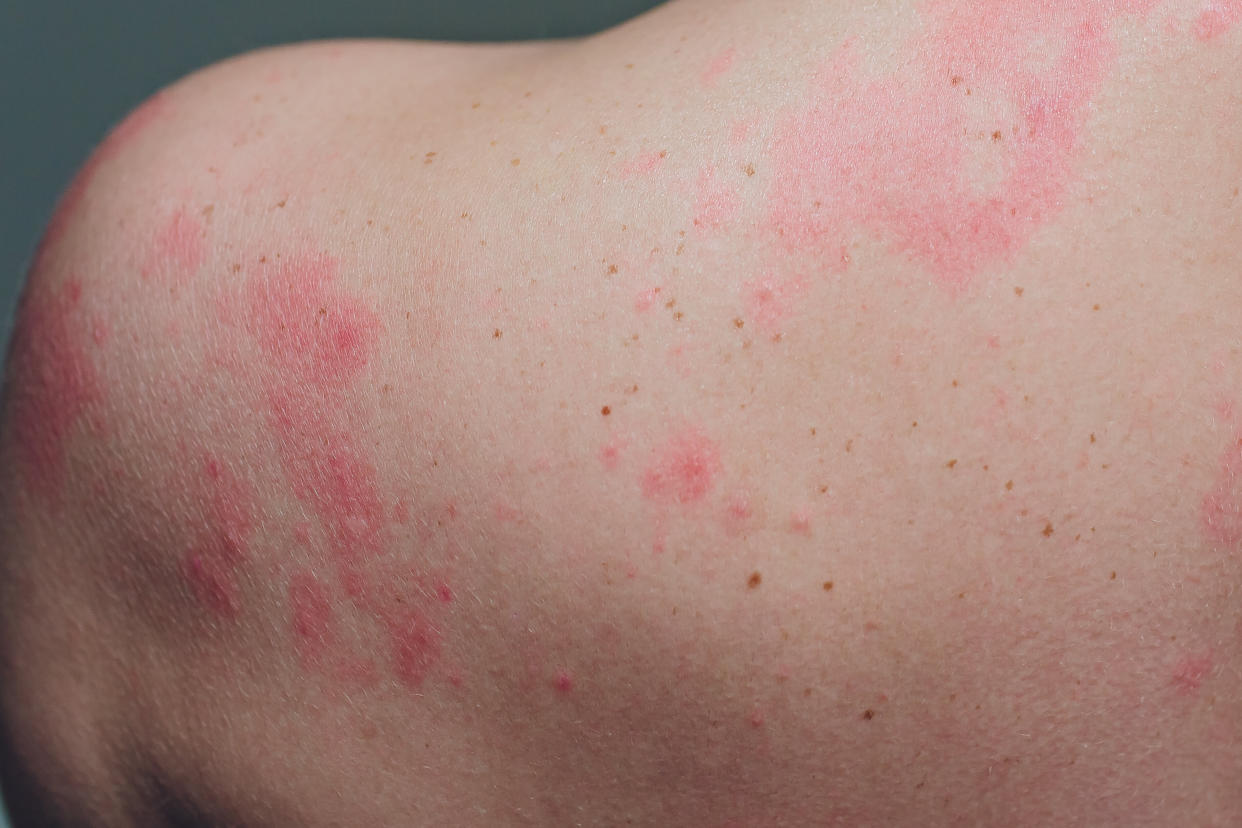 Doctors say COVID-related skin conditions may look like psoriasis or hives. 