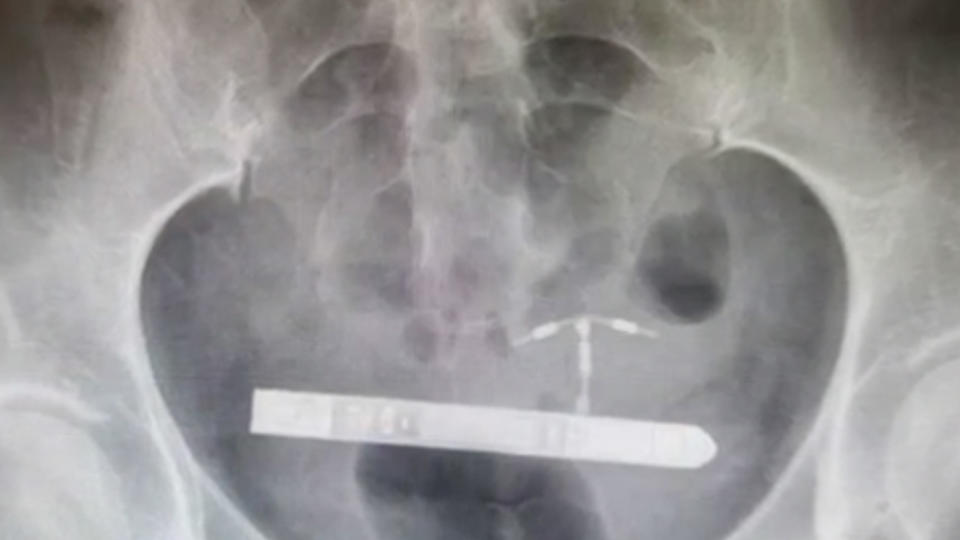 The sex toy can be seen inside the woman's bladder. Source: KMOV4