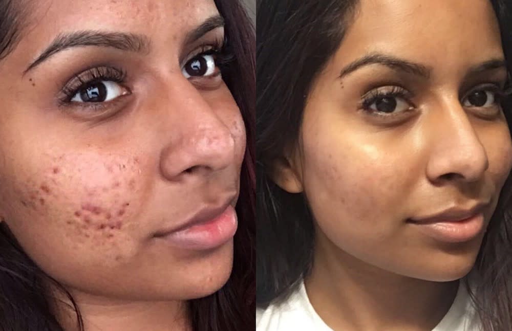 This woman’s cystic acne routine has set Twitter ablaze, but here’s what an expert thinks