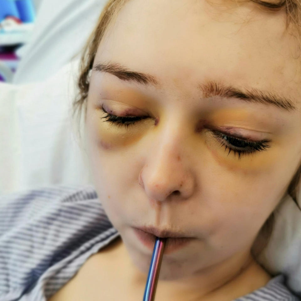 Katie Dunn after surgery drinking through a straw (SWNS)