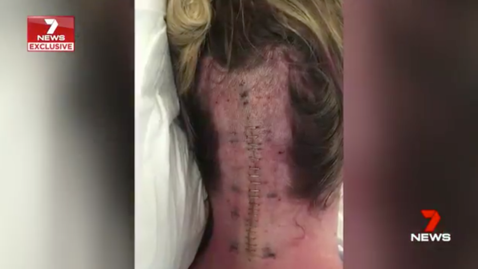 Life-saving surgery left her with a giant scar on the back of her head. Source: 7News