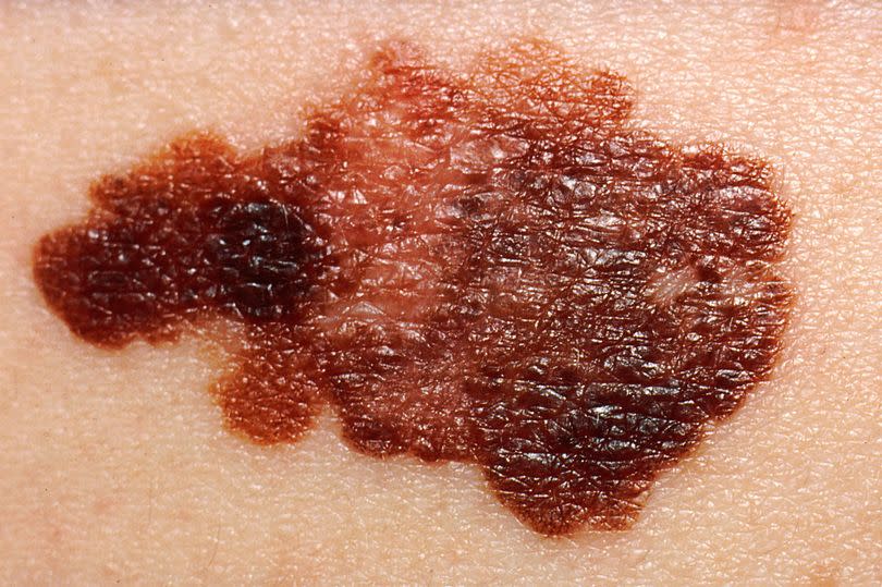 Melanoma, Skin Cancer, with coloring of different shades of brown, black, or tan.