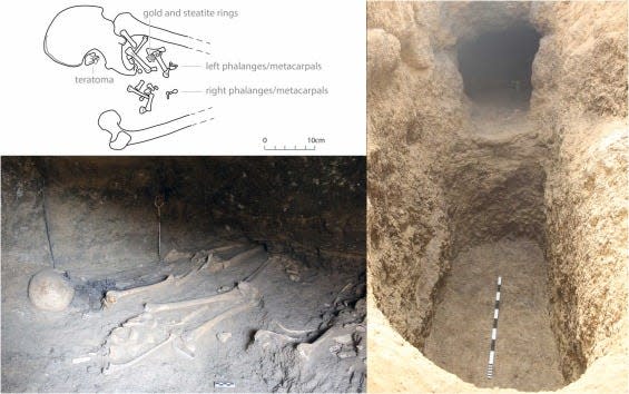 A diagram describes teh position of the teratoma and ring in the skeletal remains found in Amarna. A picture of those remains is shown below the diagram. Next to both images, a picture of a tomb is shown.