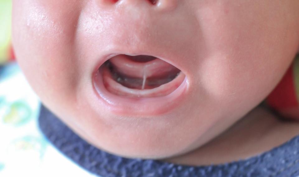 baby with open mouth shows tongue tie under tongue