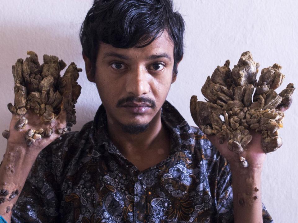 A Bangladeshi father known as "Tree Man" because of bark-like growths across his body has said he wants his hands amputated to relieve him of the pain.Abul Bajandar has had 25 operations since 2016 to remove the warts, caused by a rare genetic condition.But the growths have only continued to spread and get larger, the 28-year-old says."I cannot bear the pain anymore, I can't sleep at night,” he told the Agence France Presse news agency. “I asked the doctors to cut off my hands so I can at least get some relief.”The father-of-one suffers with epidermodysplasia verruciformis, a skin condition which has been reported in fewer than a dozen people.It causes the eruption of warts on the body’s limbs and is thought to be exacerbated by weak immune systems. Sufferers are highly prone to skin cancer.Doctors treating Mr Bajandar had previously believed they had beaten the disease but he suffered a relapse in May last year – with growths coming back bigger and quicker than before.He says he would now like to travel abroad for better treatment – but does not have the money to cover the expenses.Samanta Lal Sen, the chief plastic surgeon at Dhaka Medical College Hospital where Mr Bajandar has been treated, said a board of seven doctors will discuss the case this week.The same hospital also treated a young Bangladeshi girl suffering from the condition in 2017.Doctors declared Sahana Khatun’s surgery a success, but the then 10-year-old’s father later said the growths had returned in even greater numbers before the family halted the treatment and returned to their village.In the condition’s most famous case Dede Koswara, from Indonesia, had some 6kg of warts removed by American doctors in 2008 before he died from complications related to the condition aged just 42.