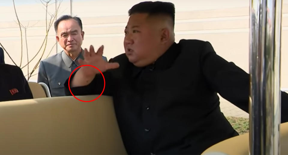 A still from newly-released footage of Kim Jong-un showing a mark on his wrist, which medical experts say indicates he has had a procedure.