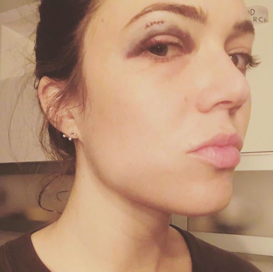 Shower door handle: 1, Mandy Moore: 0. The 'This is Us' actress posted a cringe worthy selfie to Instagram on August 31, 2017, showcasing a black eye and some fresh stiches after a nasty row with her shower door. "Shower door handle- 1, Mandy- 0. Real talk: how does a girl get rid of a black eye pronto? Any helpful hints (minus Ice and arnica??). Thanks @stokerplasticsurgery for coming in at 9pm to sew me up!! Never had stitches or a black eye before... what a day."