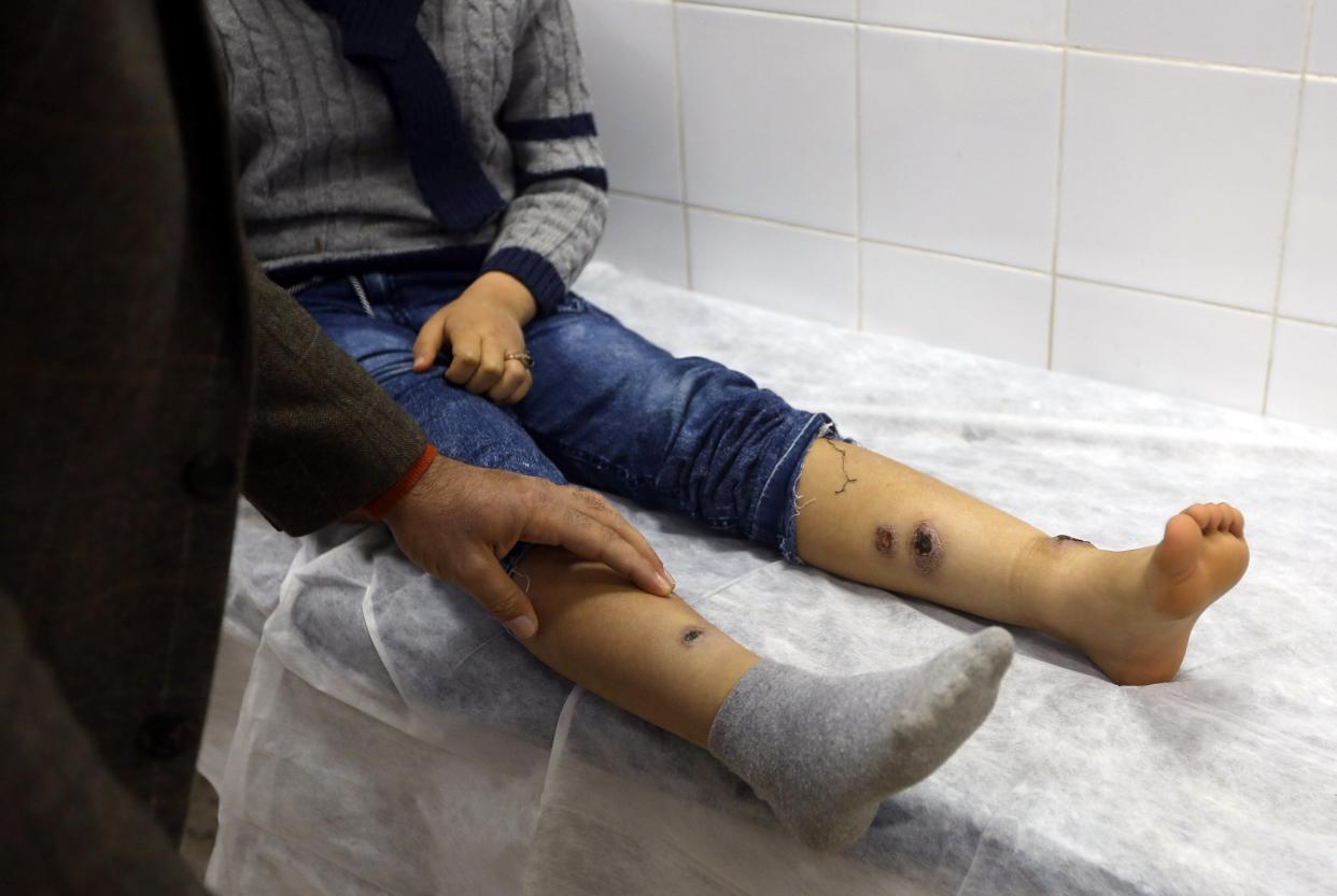 Boy receives treatment for Leishmaniasis at the Bir Al-Ostah Milad Hospital for Dermatology in the Libyan capital, Tripoli on 11 February, 2019 (AFP via Getty Images)