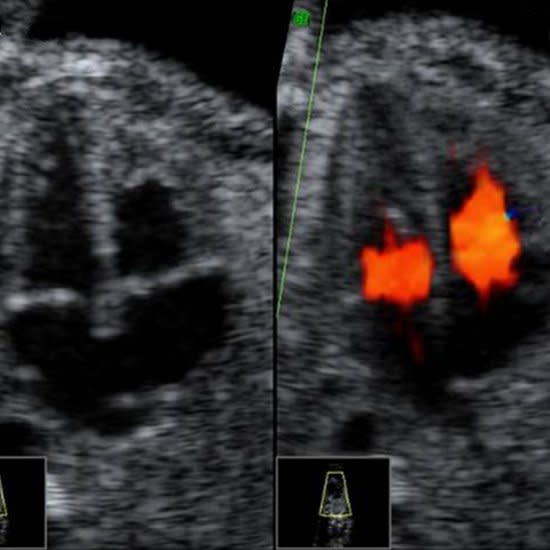 We've partnered with the American Institute of Ultrasound Medicine (AIUM), Johns Hopkins, and the March of Dimes to create this unique peak into Baby's development inside the womb. These images reveal all the intricate details of your baby's growth -- from a collection of cells to a full-term newborn. While most women may only receive one or two ultrasounds during pregnancy, which is normal, this slideshow of the 2nd trimester of pregnancy gives you a look at each week of development.