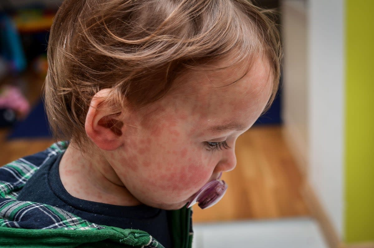 London has overtaken the West Midlands as the region with the highest number of measles cases (File picture)