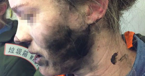 This handout photo taken on February 19, 2017 and released by the Australia Transport Safety Bureau shows a woman after she suffered burns to her face and hands after her headphones caught fire during a flight. Photo from AP.