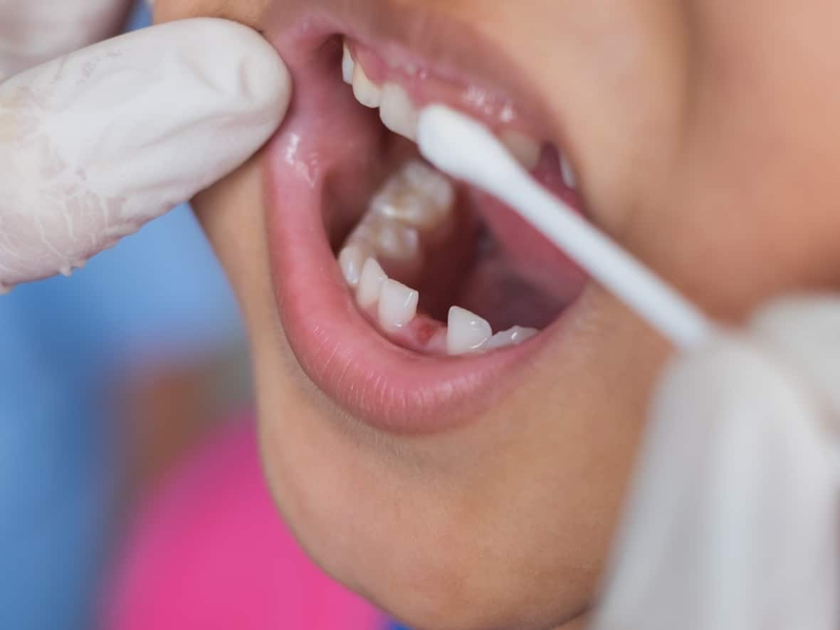 The Liberal-NDP agreement includes a plan to create a new national dental care program for low-income Canadians. (Shutterstock / chanchai plongern - image credit)