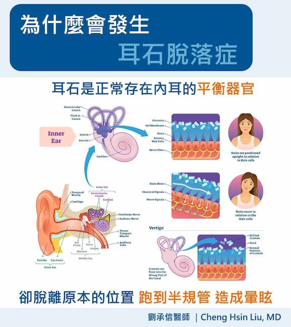 我平常很健康，為什麼會發生耳石脫落症呢？