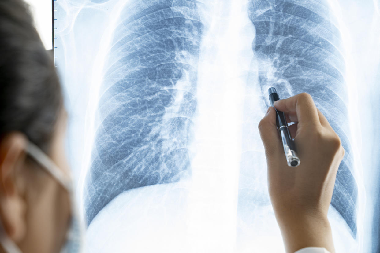 COVID-19 patients who report lingering side effects, such as trouble breathing, for weeks or months, have hope of recovering, a new study reports. (Getty Images)