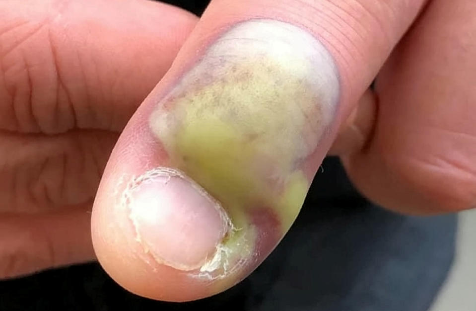 Steven's infected nail was swollen and leaking green puss [Photo: SWNS]