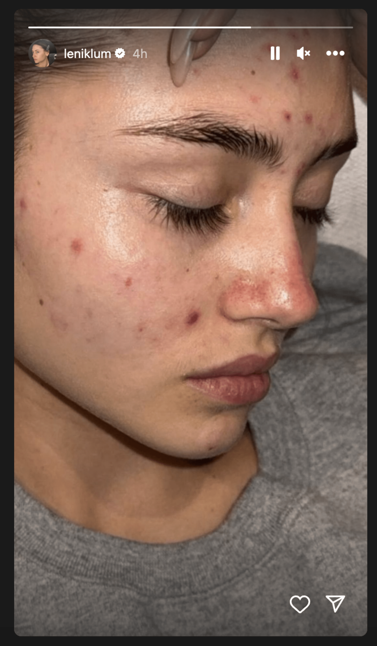 Keidi Klum's daughter, Leni, shared a photo of her acne breakout.  (Leni Klum/Instagram)
