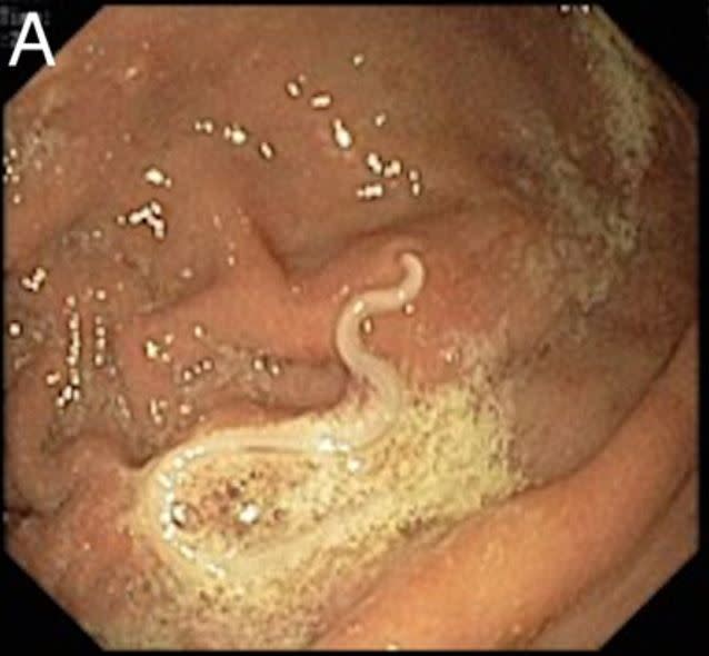 An endoscope captured footage of the unwelcome visitors in the man's stomach (BMJ Case Reports) 