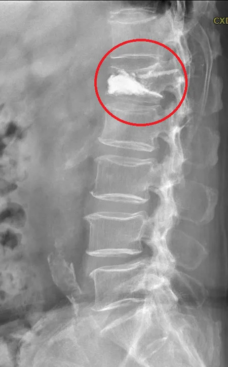 術後X光顯示，水泥注入椎體骨折處，增強椎體強度及脊椎穩定性。（台北慈濟醫院提供）