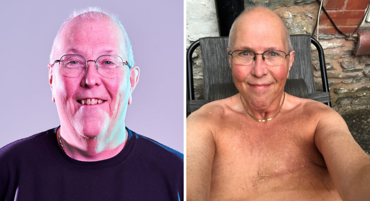 A composite image of Jim Allen who was diagnosed with breast cancer