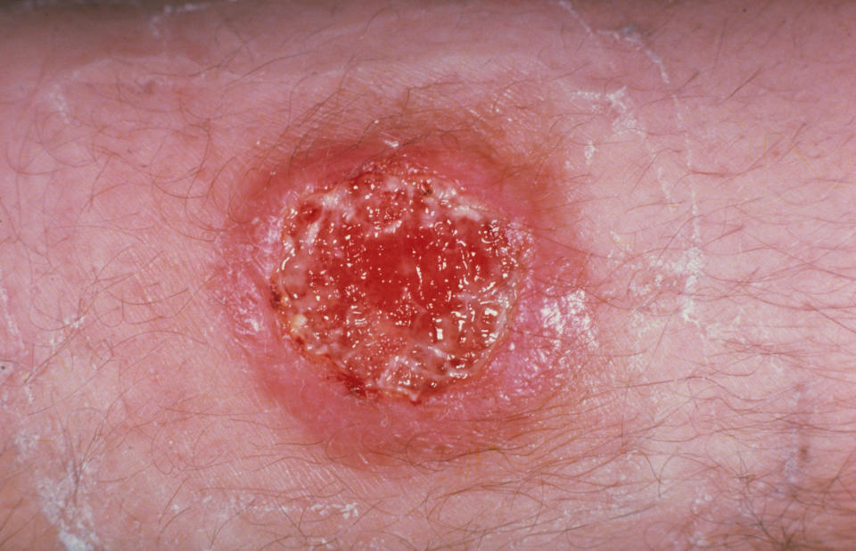 There are several forms of <a href="http://www.who.int/mediacentre/factsheets/fs375/en/" target="_blank">leishmaniasis</a>,&nbsp;including visceral, which can be fatal, with symptoms including fever and weight loss; and cutaneous, the most common form, which&nbsp;causes skin lesions, leaving lifelong scars and disability. The disease, spread by sandflies, affects some of the poorest people on earth, according to WHO, and is associated with malnutrition and poor housing. Around 1 million new cases occur annually, causing 20,000 to 30,000 deaths. Leishmaniasis is climate-sensitive, affected by changes in rainfall, temperature and humidity ― which means it could be exacerbated by global warming.