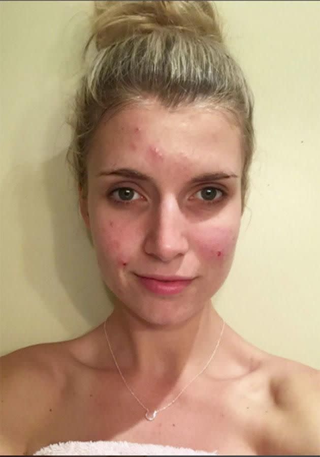 Beck Lomas shared this image of her skin on her Instagram page. Photo: Instagram/becklomas