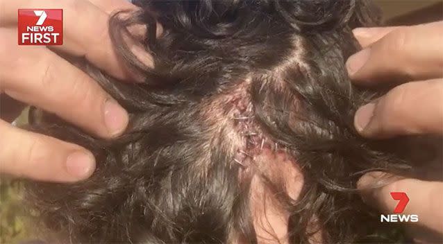 The victim of the home invasion needed several staples after being hit with a shovel. Source: 7 News